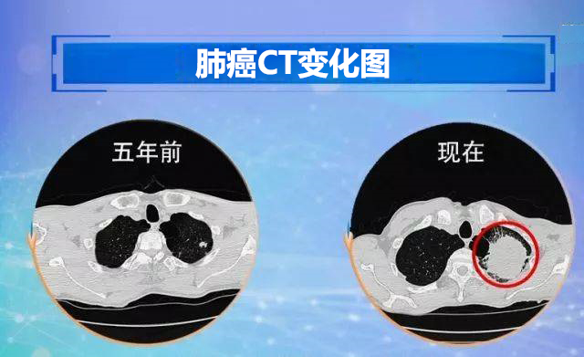 郑州治肺癌名中医