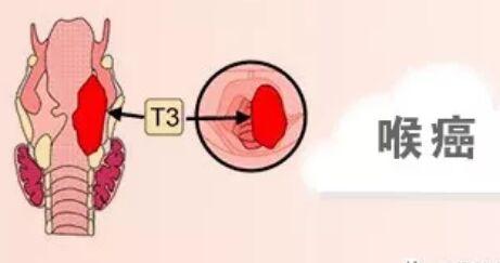 郑州治疗喉癌有名的中医:预防喉癌需要注意什么
