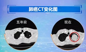 1657437508407014.jpg 肺癌2.jpg