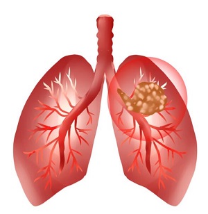 1659771125674282.jpg 肺1.jpg