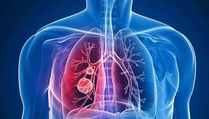 1659772266121243.jpg 肺2.jpg