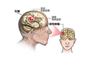 郑州看肿瘤中医馆哪家好?脑瘤的早期症状和预防