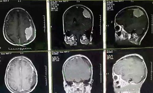 郑州看脑肿瘤有名的中医师:脑肿瘤早期有哪些信号