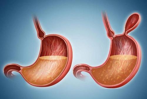 郑州御和堂：如何降低患贲门癌的风险