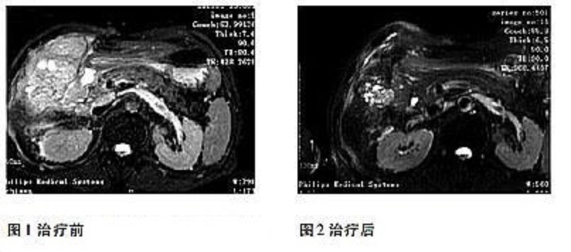 胆囊癌的早期症状是什么_郑州中医治疗胆囊癌
