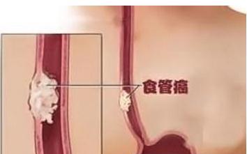 食道癌不通时期注意事项_郑州中医师治疗食道癌