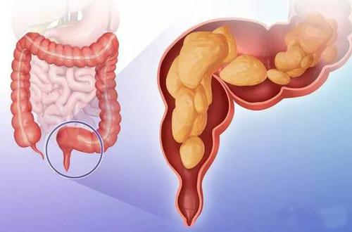 直肠癌要少吃哪些食物？以下这些食物要少吃